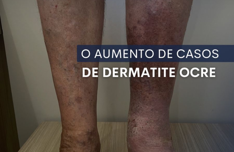 Aumento dos casos de dermatite ócre, entenda